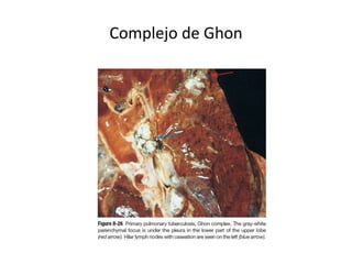Complejo de Ghon
 