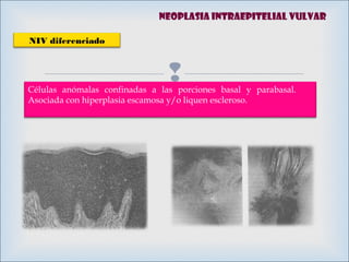 Células anómalas confinadas a las porciones basal y parabasal.
Asociada con hiperplasia escamosa y/o liquen escleroso.
Neoplasia intraepitelial vulvar
NIV diferenciado
 
