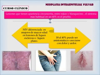 
CURSO CLÍNICO
Lesiones que tienen apariencia circunscrita, entre rojizo y blanquecino , el síntoma
mas habitual en un 60% es el prurito.
Neoplasia intraepitelial vulvar
 