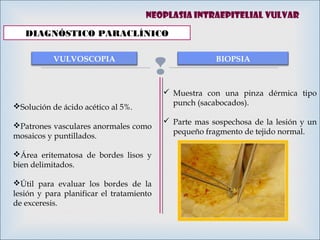 
DIAGNÓSTICO PARACLÍNICO
VULVOSCOPIA BIOPSIA
 Muestra con una pinza dérmica tipo
punch (sacabocados).
 Parte mas sospechosa de la lesión y un
pequeño fragmento de tejido normal.
Neoplasia intraepitelial vulvar
Solución de ácido acético al 5%.
Patrones vasculares anormales como
mosaicos y puntillados.
Área eritematosa de bordes lisos y
bien delimitados.
Útil para evaluar los bordes de la
lesión y para planificar el tratamiento
de exceresis.
 