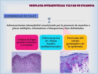 
NEOPLASIA INTRAEPITELIAL VULVAR NO ESCAMOSA
ENFERMEDAD DE PAGET
Adenocarcinoma intraepitelial caracterizado por la presencia de manchas o
placas múltiples, eritematosas o blanquecinas, bien delimitadas.
 