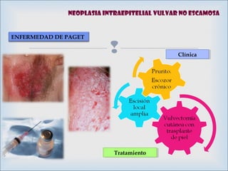 
ENFERMEDAD DE PAGET
ClínicaClínica
TratamientoTratamiento
NEOPLASIA INTRAEPITELIAL VULVAR NO ESCAMOSA
 