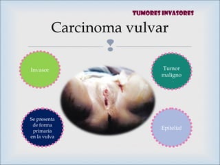 
Carcinoma vulvar
Tumor
maligno
Epitelial
Se presenta
de forma
primaria
en la vulva
Invasor
Tumores invasores
 