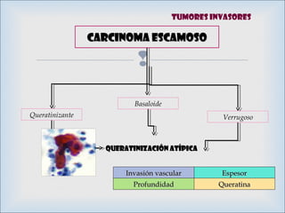 
Carcinoma escamosoCarcinoma escamoso
Basaloide
VerrugosoQueratinizante
QUERATINIZACIÓN ATÍPICAQUERATINIZACIÓN ATÍPICA
Invasión vascularInvasión vascular EspesorEspesor
ProfundidadProfundidad QueratinaQueratina
Tumores invasores
 