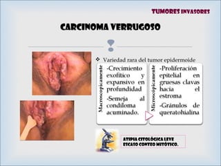 
Carcinoma verrugoso
Tumores invasores
 Variedad rara del tumor epidermoide
ATIPIA CITOLÓGICA LEVE
Escaso conteo mitótico.
 