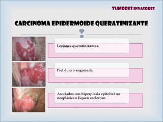 
Carcinoma epidermoide Queratinizante
Tumores invasores
 