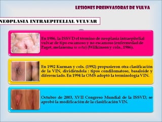 
NEOPLASIA INTRAEPITELIAL VULVAR
Lesiones preinvasoras de vulva
 