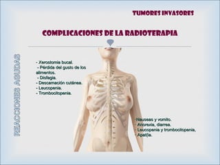 
Complicaciones de la RADIOTERAPIA
- Xerostomia bucal.Xerostomia bucal.
- Pérdida del gusto de los- Pérdida del gusto de los
alimentos.alimentos.
- Disfagia.- Disfagia.
- Descamación cutánea.- Descamación cutánea.
- Leucopenia.- Leucopenia.
- Trombocitopenia.- Trombocitopenia.
-Nauseas y vomito.Nauseas y vomito.
- Anorexia, diarrea.Anorexia, diarrea.
- Leucopenia y trombocitopenia,Leucopenia y trombocitopenia,
- Apat{ia.Apat{ia.
Tumores invasores
 