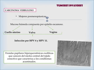 
CARCINOMA VERRUGOSO
Mucosa húmeda compuesta por epitelio escamoso.
Cuello uterino Vulva Vagina
Infección por HPV 6 y HPV 11.
Frondas papilares hiperqueratósicas exofìticas
que carecen del núcleo central del tejido
conectivo que caracteriza a los condilomas
acuminados.
• Mujeres posmenopáusicas.
Tumores invasores
 