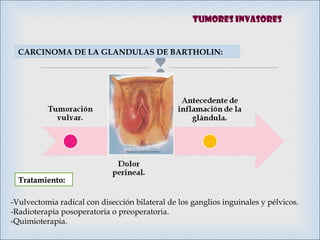 
CARCINOMA DE LA GLANDULAS DE BARTHOLIN:
Tratamiento:Tratamiento:
-Vulvectomia radical con disección bilateral de los ganglios inguinales y pélvicos.
-Radioterapia posoperatoria o preoperatoria.
-Quimioterapia.
Tumores invasores
 