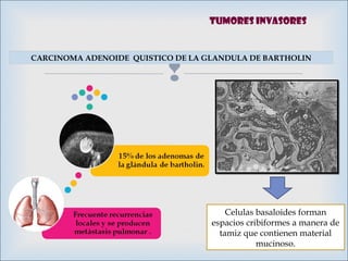 
CARCINOMA ADENOIDE QUISTICO DE LA GLANDULA DE BARTHOLIN
Celulas basaloides forman
espacios cribiformes a manera de
tamiz que contienen material
mucinoso.
Tumores invasores
 