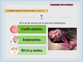 
TUMORES METASTÁSICOS DE LA VULVATUMORES METASTÁSICOS DE LA VULVA
80 % de los tumores de la vulva son metastásicos
Tumores invasores
 