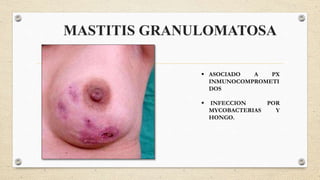 MASTITIS GRANULOMATOSA
 ASOCIADO A PX
INMUNOCOMPROMETI
DOS
 INFECCION POR
MYCOBACTERIAS Y
HONGO.
 