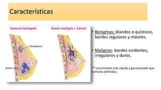Características
• Benigmas: blandos o quísticos,
bordes regulares y móviles.
• Malignas: bordes evidentes,
irregulares y duros.
** crecimiento más rápido y generalizado que
tumores definidos.
 