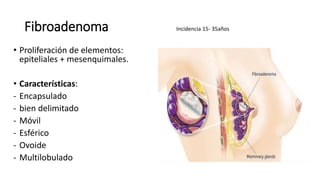 Fibroadenoma
• Proliferación de elementos:
epiteliales + mesenquimales.
• Características:
- Encapsulado
- bien delimitado
- Móvil
- Esférico
- Ovoide
- Multilobulado
Incidencia 15- 35años
 