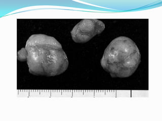 DIAGNOSTICO : GALACTOGRAFIATRATAMIENTO:Resección del conducto galactóforo.Mastectomía: si recidiva o son múltiples. 