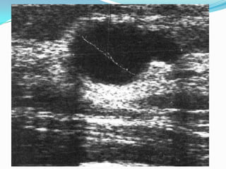 TUMOR FILODESTumor de poca frecuenciaMayores de 40 añosRedondeado, nodular,indoloroÚnico en el 85% de los casos.Está constituido por un componente epitelial y otro estromal