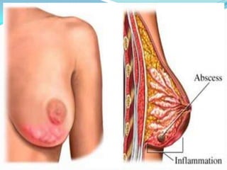 Cambios Fibroquísticos-------FIBROSIS------ADENOSIS--------PAPILOMATOSISPapiloma IntraductalEctasia DuctalHIPERPLASIAS