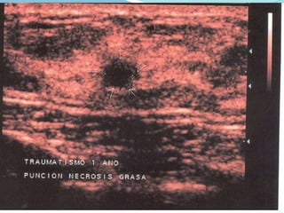 Patológica: farmacol. endocrino – tumoralPURULENTA: Relacionada con mastitisMULTICOLOR: Ectasia ductal SEROSA – SANGUINOLENTA: Papiloma Intraductal 