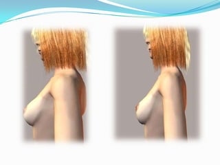 4ta. ; el pezón y la areola forman un montículo separado, la menstruación inicia dos años después. 5ta. : la mama termina su crecimiento durante la pubertad alcanzando su forma redondeada. 