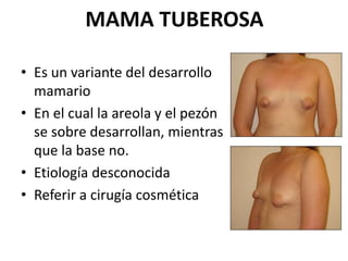 MAMA TUBEROSA
• Es un variante del desarrollo
mamario
• En el cual la areola y el pezón
se sobre desarrollan, mientras
que la base no.
• Etiología desconocida
• Referir a cirugía cosmética
 