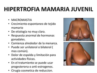 HIPERTROFIA MAMARIA JUVENIL
• MACROMASTIA
• Crecimiento espontaneo de tejido
mamario
• De etiología no muy clara.
• Respuesta anormal de hormonas
gonadales.
• Comienza alrededor de la menarca.
• Puede ser unilateral o bilateral (
mas común).
• Dolor de espalda y limitación para
actividades físicas.
• En el tratamiento se puede usar
progesterona o anti-estrogenos.
• Cirugia cosmetica de reduccion.
 