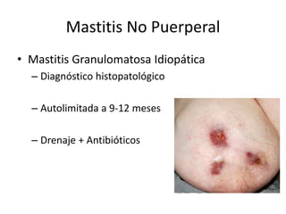 Mastitis No Puerperal
• Mastitis Granulomatosa Idiopática
– Diagnóstico histopatológico
– Autolimitada a 9-12 meses
– Drenaje + Antibióticos
 