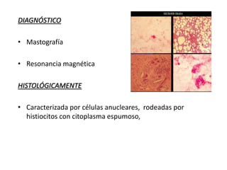 DIAGNÓSTICO
• Mastografía
• Resonancia magnética
HISTOLÓGICAMENTE
• Caracterizada por células anucleares, rodeadas por
histiocitos con citoplasma espumoso,
 