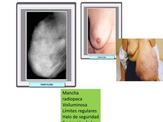 Mancha
radiopaca
Voiluminosa
Límites regulares
Halo de seguridad
 