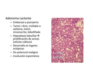 Adenoma Lactante
– Embarazo y puerperio
– Tumor <3cm, múltiple o
solitario, móvil,
circunscrita, lobullillada
– Hiperplasia lobulillar
proliferación de acinos
(células cúbicas)
– Desarrollo en lugares
ectópicos
– Sin potencial maligno
– Involución espontánea
 