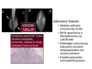 Adenoma Tubular
• Nódulo solitario,
circunscrito, firme
• RX apariencia a
fibroadenoma no
calcificado
• Histología: estructuras
tubulares-acinares
empaquetados con
escaso estroma
• Pueden presentar
microcalcificaciones
 