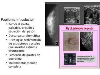Papiloma intraductal
• Tumor discreto,
palpable, erosión y
secreción del pezón
• Descarga serohemática
• Histología: proliferación
de estructuras ductales
que invaden estroma
circundante
• Presencia de quistes de
queratina
• Tratamiento: escisión
completa
 