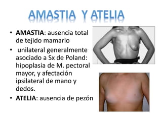 • AMASTIA: ausencia total
de tejido mamario
• unilateral generalmente
asociado a Sx de Poland:
hipoplasia de M. pectoral
mayor, y afectación
ipsilateral de mano y
dedos.
• ATELIA: ausencia de pezón
 