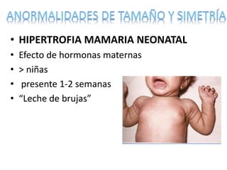 • HIPERTROFIA MAMARIA NEONATAL
• Efecto de hormonas maternas
• > niñas
• presente 1-2 semanas
• “Leche de brujas”
 