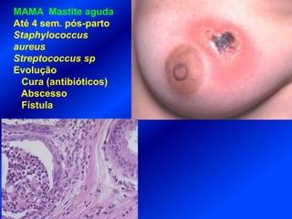 MAMA Mastite aguda
Até 4 sem. pós-parto
Staphylococcus
aureus
Streptococcus sp
Evolução
Cura (antibióticos)
Abscesso
Fístula
 