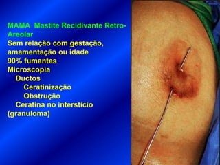 MAMA Mastite Recidivante Retro-
Areolar
Sem relação com gestação,
amamentação ou idade
90% fumantes
Microscopia
Ductos
Ceratinização
Obstrução
Ceratina no interstício
(granuloma)
 