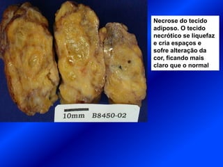 Necrose do tecido
adiposo. O tecido
necrótico se liquefaz
e cria espaços e
sofre alteração da
cor, ficando mais
claro que o normal
 