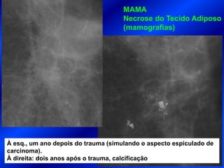 À esq., um ano depois do trauma (simulando o aspecto espiculado de
carcinoma).
À direita: dois anos após o trauma, calcificação
MAMA
Necrose do Tecido Adiposo
(mamografias)
 