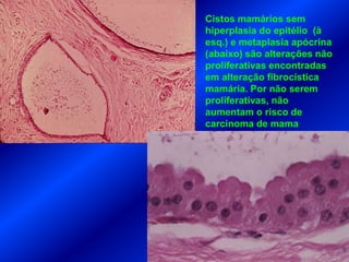 Cistos mamários sem
hiperplasia do epitélio (à
esq.) e metaplasia apócrina
(abaixo) são alterações não
proliferativas encontradas
em alteração fibrocística
mamária. Por não serem
proliferativas, não
aumentam o risco de
carcinoma de mama
 