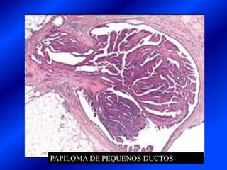 PAPILOMA DE PEQUENOS DUCTOS
 