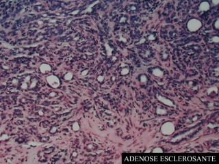 ADENOSE ESCLEROSANTE
 
