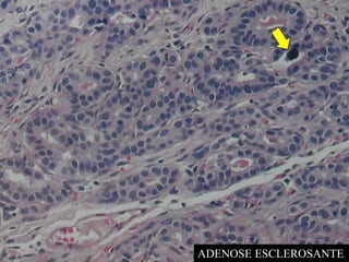 ADENOSE ESCLEROSANTE
 