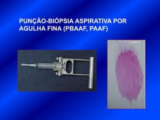 PUNÇÃO-BIÓPSIA ASPIRATIVA POR
AGULHA FINA (PBAAF, PAAF)
 