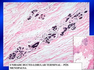 UNIDADE DUCTO-LOBULAR TERMINAL – PÓS
MENOPAUSA
 