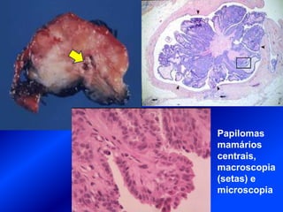 Papilomas
mamários
centrais,
macroscopia
(setas) e
microscopia
 