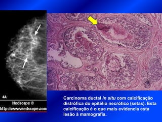Carcinoma ductal in situ com calcificação
distrófica do epitélio necrótico (setas). Esta
calcificação é o que mais evidencia esta
lesão à mamografia.
 