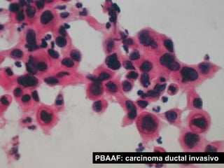 PBAAF: carcinoma ductal invasivo
 