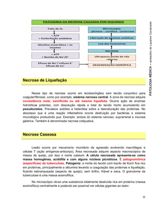 35
Necrose de Liquefação
Nesse tipo de necrose ocorre em tecidos/órgãos sem tecido conjuntivo para
coagular/fibrosar, como por exemplo, sistema nervoso central. A zona de necrose adquire
consistência mole, semifluida ou até mesmo liquefeita. Ocorre ação de enzimas
hidrolíticas potentes, com dissolução rápida e total do tecido morto acumulando em
pseudocistos. Prevalece autólise e heterólise sobre a desnaturação das proteínas. No
abscesso que é uma reação inflamatória ocorre destruição por bactérias e sistema
imunológico produzindo pus. Exemplo: anóxia do sistema nervoso, suprarrenal e mucosa
gástrica. Também é denominada necrose coliquativa.
Necrose Caseosa
Lesão ocorre por mecanismo imunitário de agressão evolvendo macrófagos e
células T (ação antígenos-anticorpo). Área necrosada adquire aspecto macroscópico de
massa de queijo, por isso o nome caseum. A célula necrosada apresenta-se como
massa homogênea, acidófila e com alguns núcleos picnóticos. É patognomônica
(específicas) da tuberculose. Patogenia: a morte do tecido com bacilo de Koch fica rico
em proteínas, principalmente a albumina levando a coagulação das proteínas e liquefação,
ficando esbranquiçada (aspecto de queijo), sem brilho, friável e seca. O granuloma da
tuberculose é uma massa eosinofílica.
No microscópio vê-se uma substancia totalmente destruída rica em proteína (massa
eosinofílica) centralmente e podendo ser possível ver células gigantes ao redor.
 