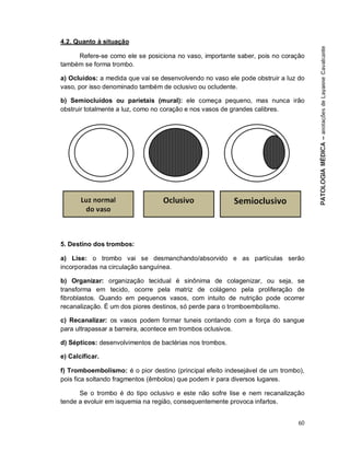 60
4.2. Quanto à situação
Refere-se como ele se posiciona no vaso, importante saber, pois no coração
também se forma trombo.
a) Ocluídos: a medida que vai se desenvolvendo no vaso ele pode obstruir a luz do
vaso, por isso denominado também de oclusivo ou ocludente.
b) Semiocluídos ou parietais (mural): ele começa pequeno, mas nunca irão
obstruir totalmente a luz, como no coração e nos vasos de grandes calibres.
5. Destino dos trombos:
a) Lise: o trombo vai se desmanchando/absorvido e as partículas serão
incorporadas na circulação sanguínea.
b) Organizar: organização tecidual é sinônima de colagenizar, ou seja, se
transforma em tecido, ocorre pela matriz de colágeno pela proliferação de
fibroblastos. Quando em pequenos vasos, com intuito de nutrição pode ocorrer
recanalização. É um dos piores destinos, só perde para o tromboembolismo.
c) Recanalizar: os vasos podem formar tuneis contando com a força do sangue
para ultrapassar a barreira, acontece em trombos oclusivos.
d) Sépticos: desenvolvimentos de bactérias nos trombos.
e) Calcificar.
f) Tromboembolismo: é o pior destino (principal efeito indesejável de um trombo),
pois fica soltando fragmentos (êmbolos) que podem ir para diversos lugares.
Se o trombo é do tipo oclusivo e este não sofre lise e nem recanalização
tende a evoluir em isquemia na região, consequentemente provoca infartos.
 