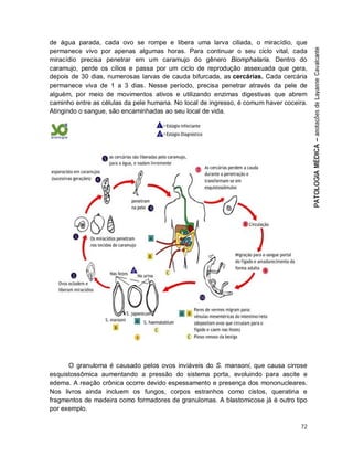 72
de água parada, cada ovo se rompe e libera uma larva ciliada, o miracídio, que
permanece vivo por apenas algumas horas. Para continuar o seu ciclo vital, cada
miracídio precisa penetrar em um caramujo do gênero Biomphalaria. Dentro do
caramujo, perde os cílios e passa por um ciclo de reprodução assexuada que gera,
depois de 30 dias, numerosas larvas de cauda bifurcada, as cercárias. Cada cercária
permanece viva de 1 a 3 dias. Nesse período, precisa penetrar através da pele de
alguém, por meio de movimentos ativos e utilizando enzimas digestivas que abrem
caminho entre as células da pele humana. No local de ingresso, é comum haver coceira.
Atingindo o sangue, são encaminhadas ao seu local de vida.
O granuloma é causado pelos ovos inviáveis do S. mansoni, que causa cirrose
esquistossômica aumentando a pressão do sistema porta, evoluindo para ascite e
edema. A reação crônica ocorre devido espessamento e presença dos mononucleares.
Nos livros ainda incluem os fungos, corpos estranhos como cistos, queratina e
fragmentos de madeira como formadores de granulomas. A blastomicose já é outro tipo
por exemplo.
 
